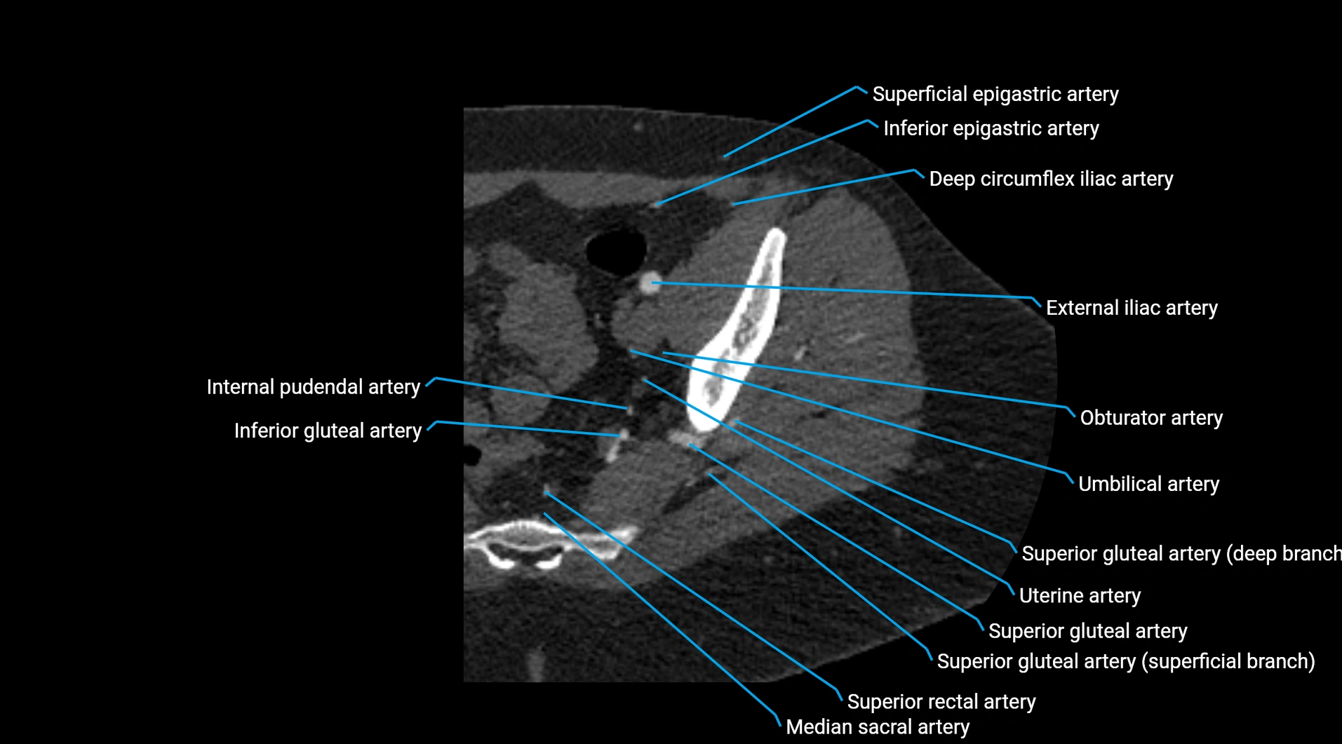 CTA lower limb cross sectional anatomy labelled image _37.webp